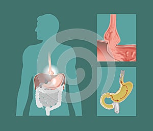 Hiatal hernia photo