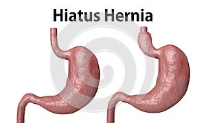 The hiatal hernia is the advancement of part of the stomach towards the esophagus, isolated over white background photo