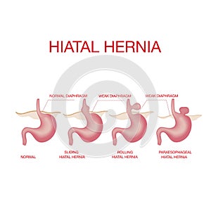 Hiatal hernia. Hiatal hernia and normal anatomy of the stomach