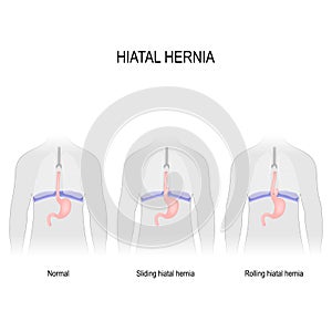 Hiatal hernia photo