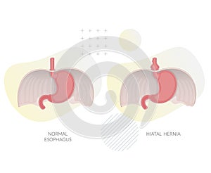 Hiatal Hernia - Hiatus Opening in Diaphragm - Stock Illustration photo