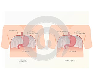 Hiatal Hernia - Hiatus Opening in Diaphragm - Stock Illustration photo