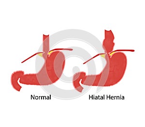 Hiatal hernia and normal anatomy of the stomach and esophagus
