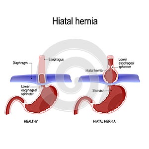 Hiatal hernia. Vector diagram of Normal anatomy and sliding hiatal hernia