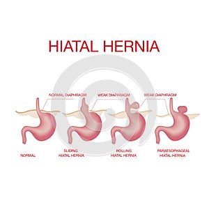 Hiatal hernia. Hiatal hernia and normal anatomy of the stomach photo