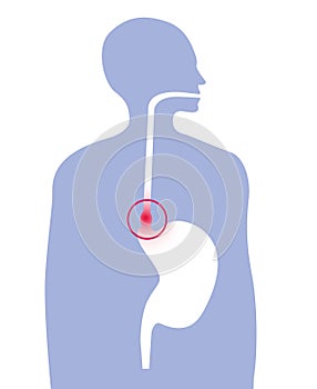 Hiatus hernia medical artwork