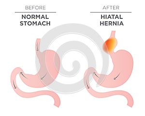 Hiatus Hernia Stomach Image