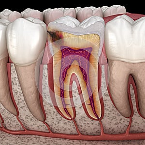 Hidden caries in to molar tooth. Medically accurate 3D illustration