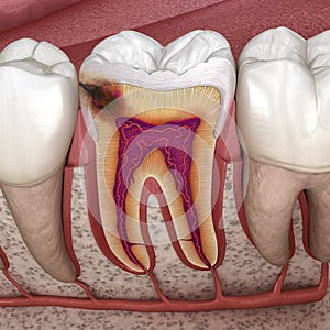 Hidden caries in to molar tooth. Medically accurate 3D illustration