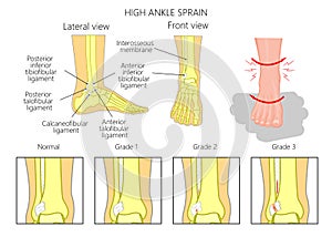 High ankle sprain photo