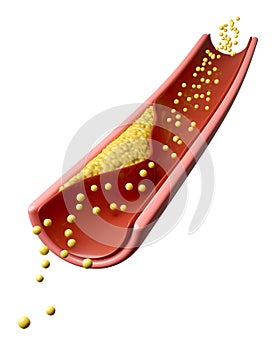 High cholesterol in artery isolated background