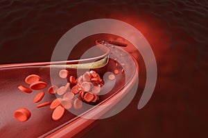 High cholesterol blocked blood cell in artery photo