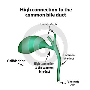 High connection to the common bile duct. Pathology of the gallbladder. photo