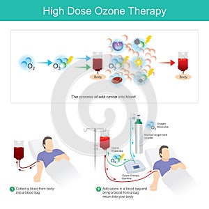 High Dose Ozone Therapy.