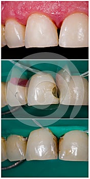 High-end nanohybrid dental filling