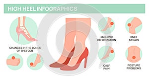 High heels harm for female feet. Foot disease medical poster. Deformity of bones and joints. Orthopedic problem
