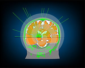 High intensity focused ultrasound targeting at human brain