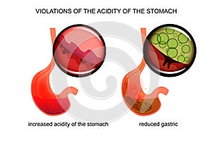 High and low acidity of the stomach photo