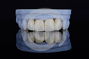 High-quality naturally dental single crowns made of zirconium for fixation to the frontal teeth of upper jaw.