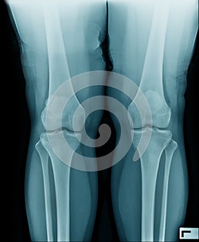 High quality x-ray knee joint of old man