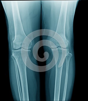 high quality x-ray knee joint of old man