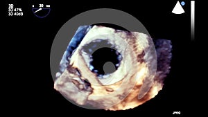 High-quality video ultrasound transesophageal examination of the heart.