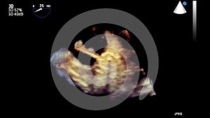 High-quality video ultrasound transesophageal examination of the heart.