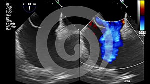 High-quality video ultrasound transesophageal examination of the heart.