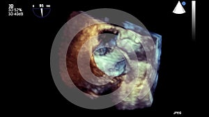 High-quality video ultrasound transesophageal examination of the heart.