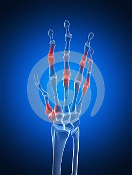 Highlighted arthritic hand