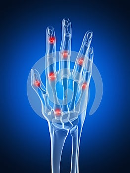 Highlighted arthritic hand