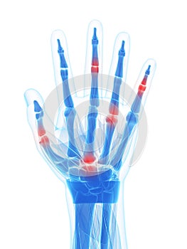 Highlighted arthritic hand