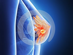 Highlighted breast cancer