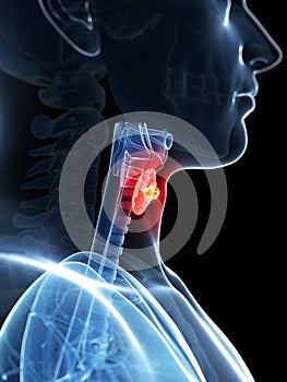 Highlighted thyroid cancer
