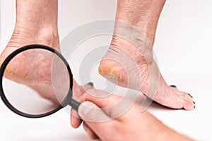 Highly dry heels woman on a white background closeup through a magnifying glass