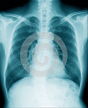 Hight qaulity chest x-ray image