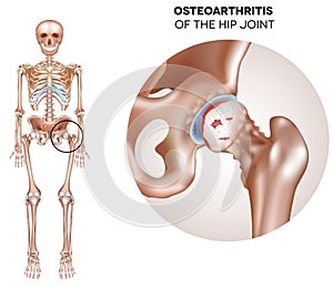 Hip Arthritis