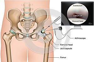 Hip arthroscopy 3d medical vector illustration on white background