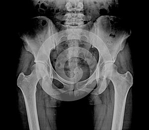 Hip Bone Xray, Human Body