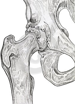 Hip - Bones Arthritis