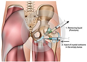 Hip bursa injection 3d medical vector illustration isolated on white background