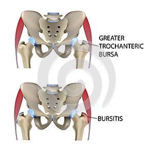 Hip bursitis, vector medical illustration photo