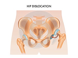 Hip dislocation illustration