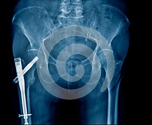 Hip fixation for old patient with hip fracture