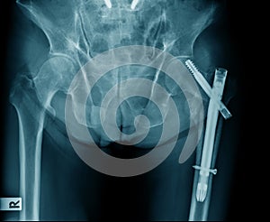 Hip fixation for old patient with hip fracture
