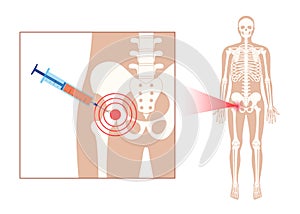 Hip joint injection photo