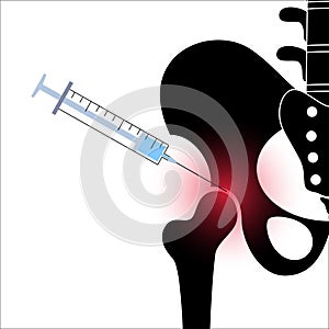 Hip joint injection photo