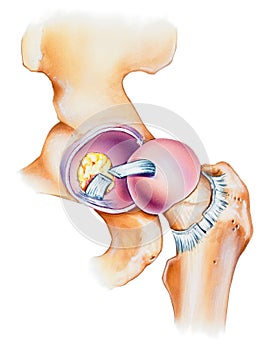 Hip - Joint Opened Lateral View