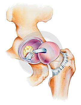 Hip - Joint Opened Lateral View photo