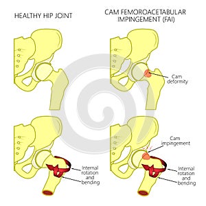 Hip joint problem_Cam femoroacetabular impingement with section